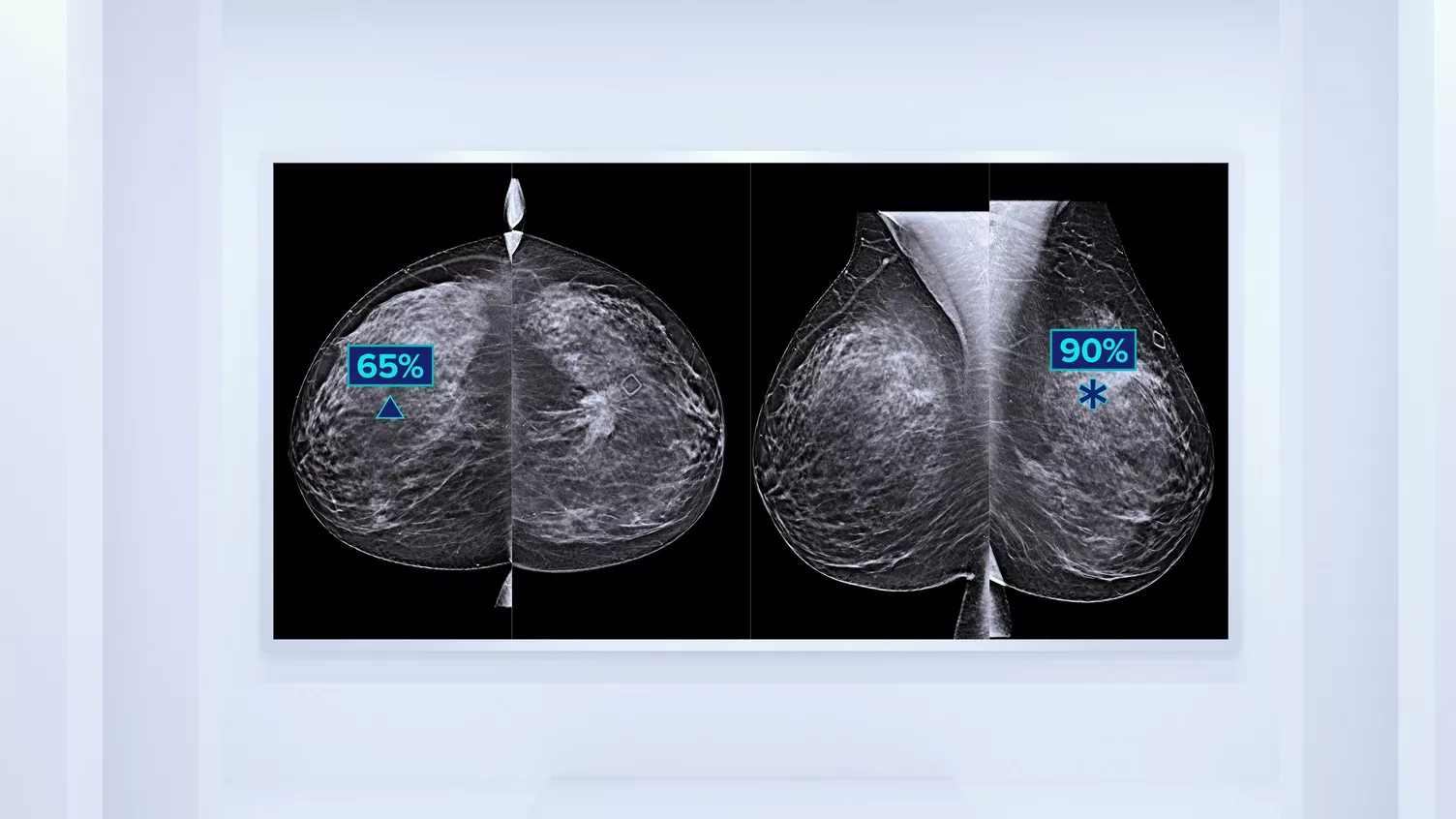 Breast scan images